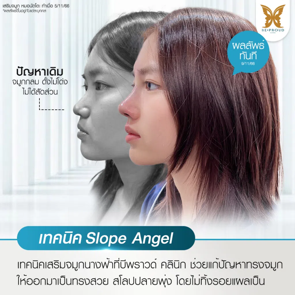 เสริมจมูก Bproud Clinic