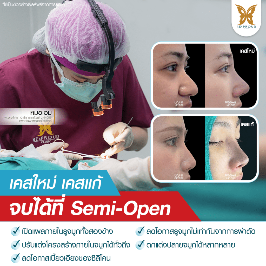 ฺเสริมจมูก Bproud Clinic