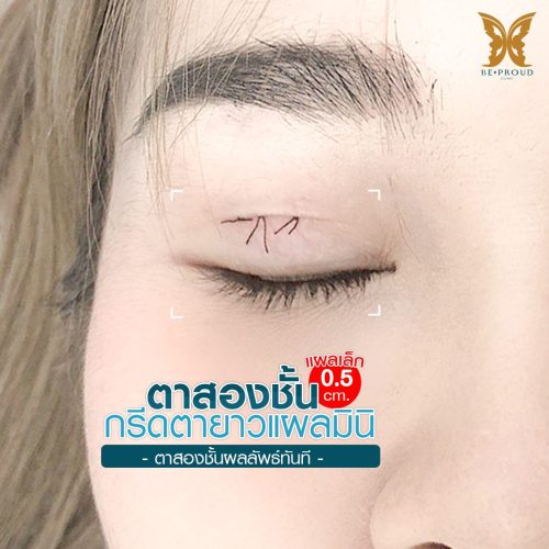 ตาสองชั้น ศัลยกรรมตาสองชั้น เทคนิคทำตาสองชั้น รีวิวทำตาสองชั้น ตาสองชั้น ศัลยกรรมตาสองชั้น เทคนิคทำตาสองชั้น รีวิวทำตาสองชั้น