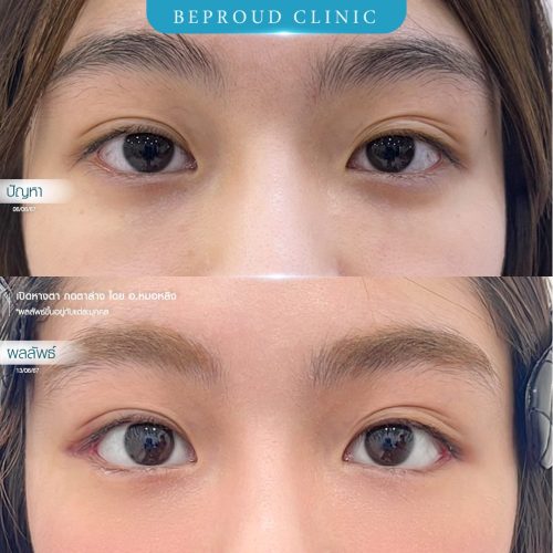 เคสเปิดหางตา อ.หมอหลิง เบล6667 ตัดไหม