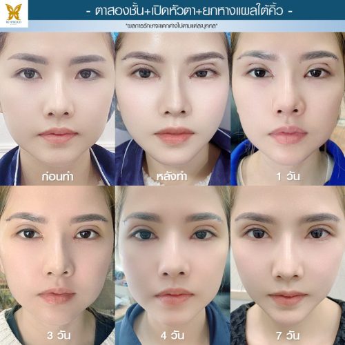 ตาสองชั้น ศัลยกรรมตาสองชั้น เทคนิคทำตาสองชั้น รีวิวทำตาสองชั้น ตาสองชั้น ศัลยกรรมตาสองชั้น เทคนิคทำตาสองชั้น รีวิวทำตาสองชั้น