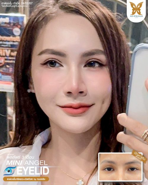 ตาสองชั้น ศัลยกรรมตาสองชั้น เทคนิคทำตาสองชั้น รีวิวทำตาสองชั้น ตาสองชั้น ศัลยกรรมตาสองชั้น เทคนิคทำตาสองชั้น รีวิวทำตาสองชั้น