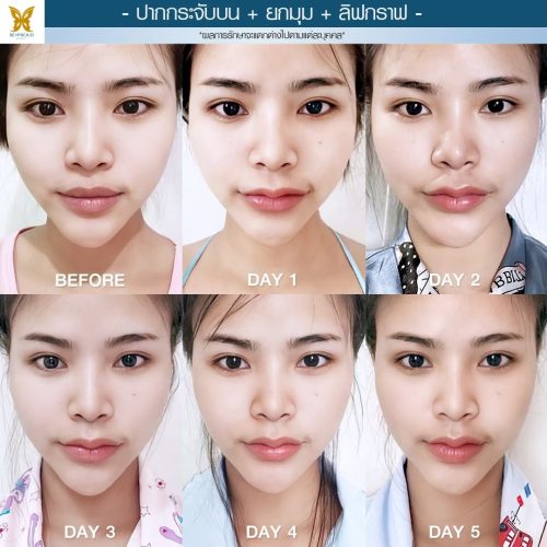ผ่าตัดปากกระจับ ผ่าตัดปากกระจับ