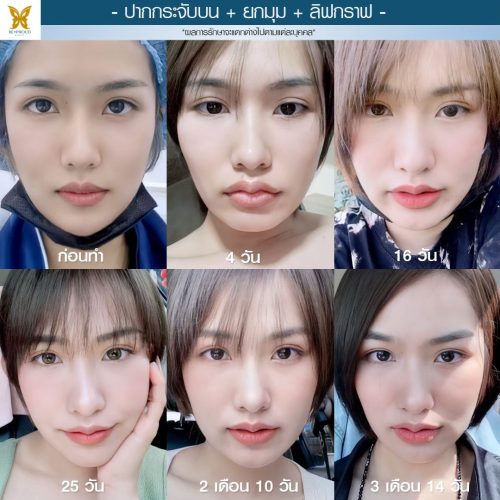 ผ่าตัดปากกระจับ ผ่าตัดปากกระจับ