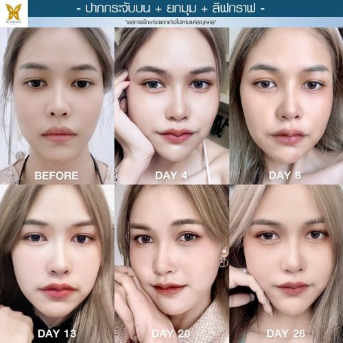 ผ่าตัดปากกระจับ ผ่าตัดปากกระจับ