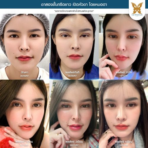 เปิดหัวตา, เปิดหัวตาคือ, เปิดหัวตาดีไหม, เปิดหัวตาเหมาะกับใคร, ข้อดีข้อเสียเปิดหัวตา, รีวิวเปิดหัวตา