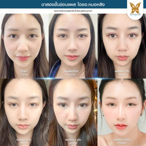 เปิดหัวตา, เปิดหัวตาคือ, เปิดหัวตาดีไหม, เปิดหัวตาเหมาะกับใคร, ข้อดีข้อเสียเปิดหัวตา, รีวิวเปิดหัวตา