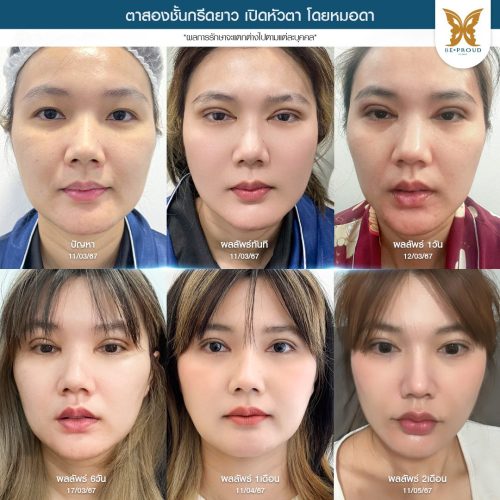 เปิดหัวตา, เปิดหัวตาคือ, เปิดหัวตาดีไหม, เปิดหัวตาเหมาะกับใคร, ข้อดีข้อเสียเปิดหัวตา, รีวิวเปิดหัวตา