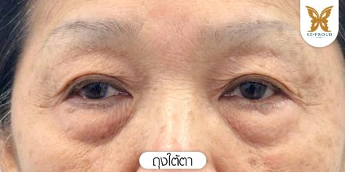 ถุงใต้ตา ถุงใต้ตา