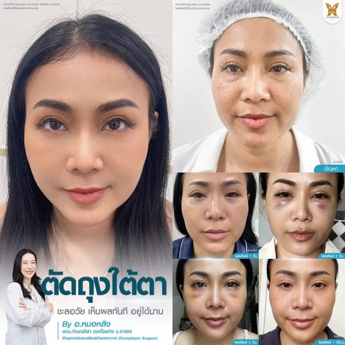 ถุงใต้ตา จุ๋ม25467 หมอหลิง ถุงใต้ตา จุ๋ม25467 หมอหลิง