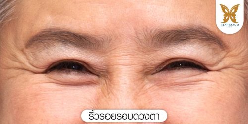 ริ้วรอยรอบดวงตา ริ้วรอยรอบดวงตา