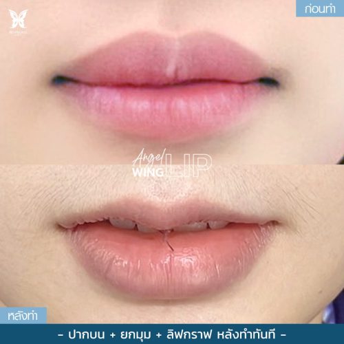 ผ่าตัดปากกระจับ ผ่าตัดปากกระจับ