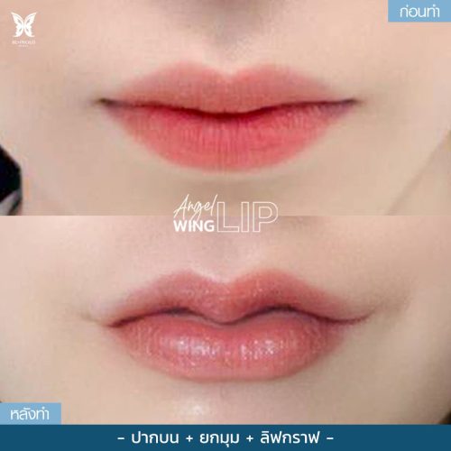 ผ่าตัดปากกระจับ ผ่าตัดปากกระจับ